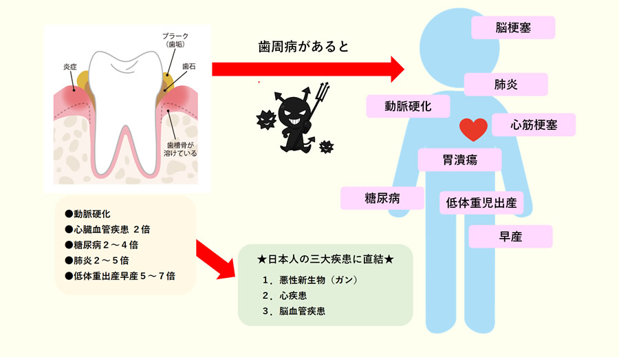 歯周病